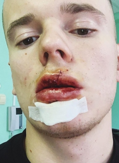 Арсений Шульгин, операция, губы|Фото: Instagram Арсений Шульгин